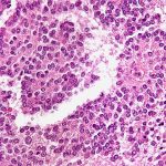 VUB brengt complexiteit van pancreastumoren in kaart