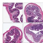 Nieuwe inzichten in parkinson en inflammatoire darmziekten bieden hoop