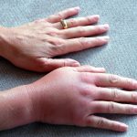 Immunotherapie met insectengif