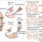 ‘Alzheimer raakt ontrafeld’