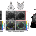 Verbetering beeldvorming abdominale aneurysma’s