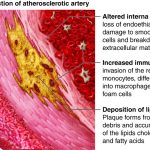 Onderzoek naar nieuwe behandeling tegen slagaderverkalking