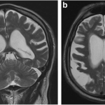 Grootschalig Vlaams alzheimeronderzoek