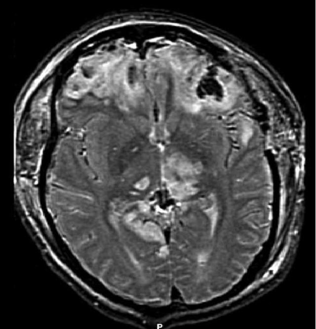 MRI brein met schade